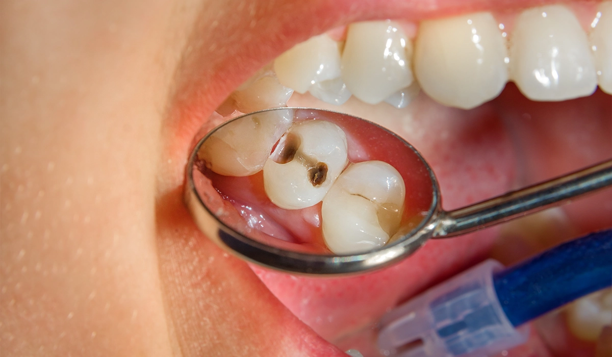 子ども虫歯の特徴
