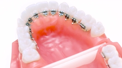 裏側のワイヤー矯正