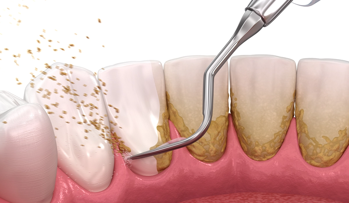 歯周基本治療（スケーリング・ルートプレーニング）