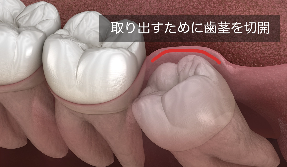 歯茎の切開